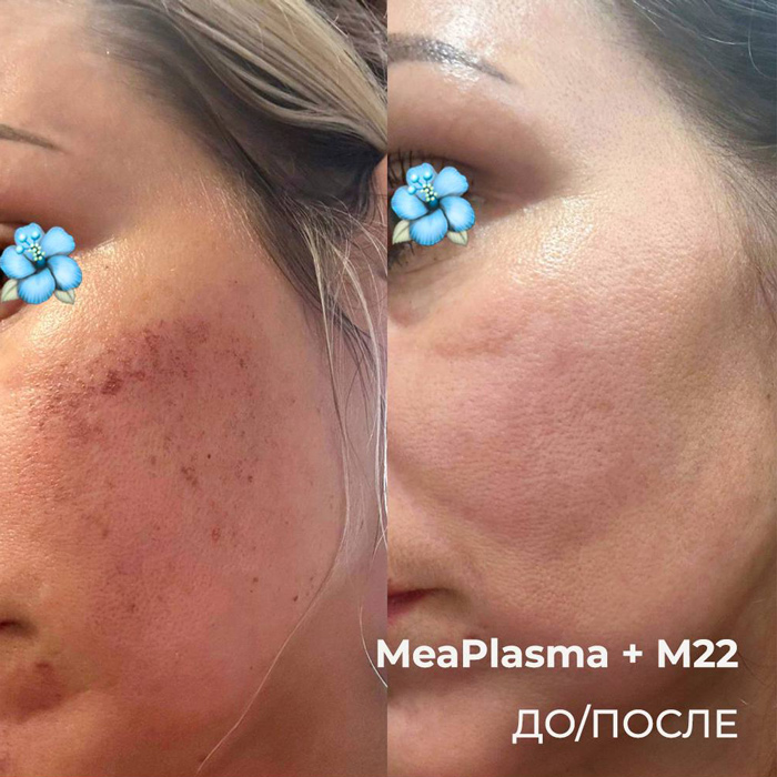 Фотоомоложение M22 IPL