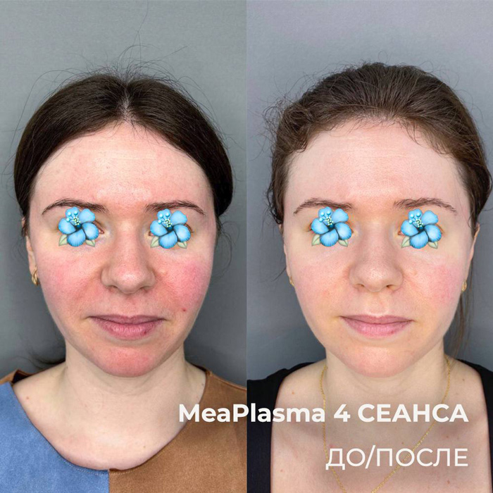 MeaPlasma